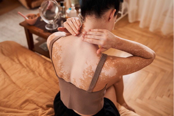 O que é o vitiligo?
